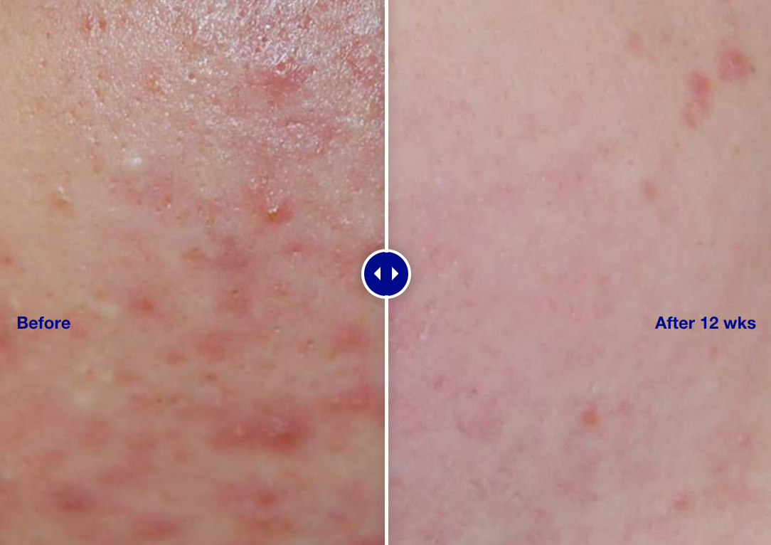iS Clinical Active Serum
