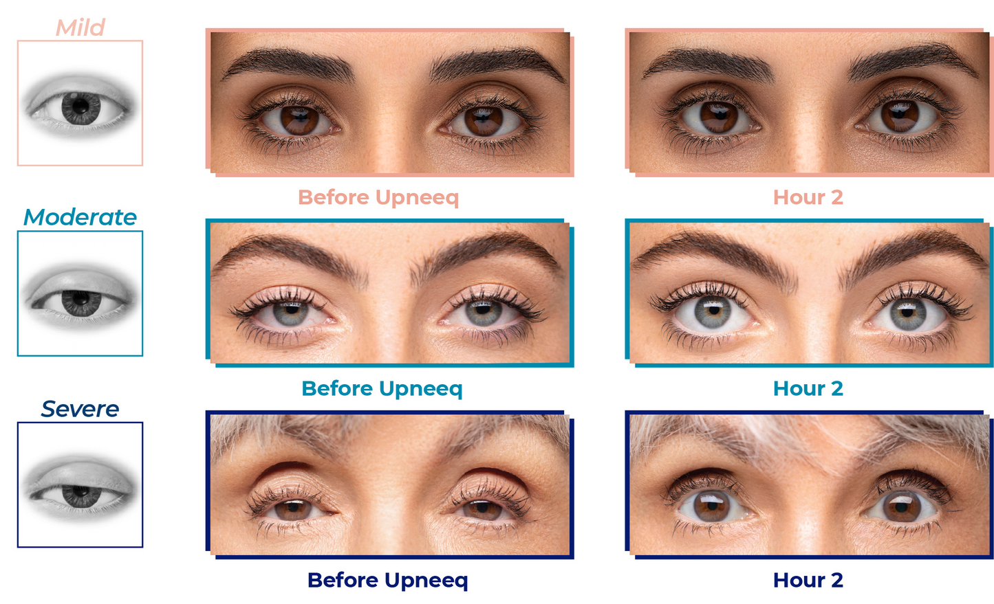 Upneeq Eye Drops